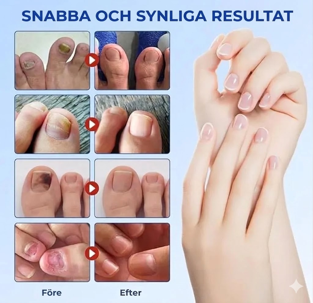 NagelFix™ – Svampdödande Nagelplåster för Friskare Naglar