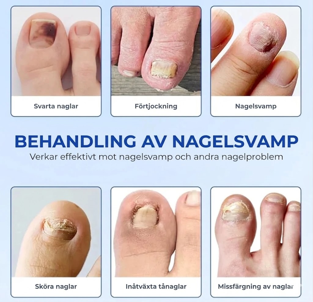 NagelFix™ – Svampdödande Nagelplåster för Friskare Naglar