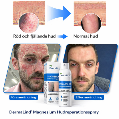 DermaLind™ – Magnesium hudreparerande spray för känslig och irriterad hud