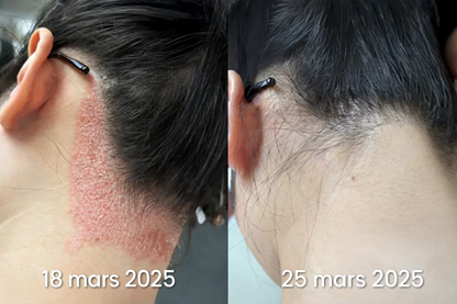DermaLind™ – Magnesium hudreparerande spray för känslig och irriterad hud