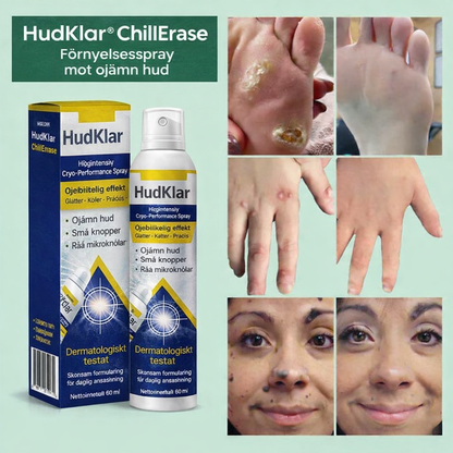 HudKlar™ ChillErase – Precisionskylande spray för slätare hud