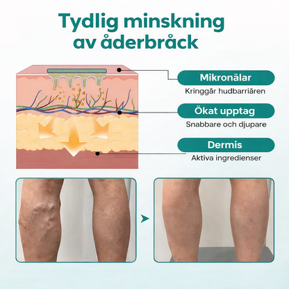 VenaLindra™ – Mikronålsplåster för stöd av vener och lindring av tunga ben