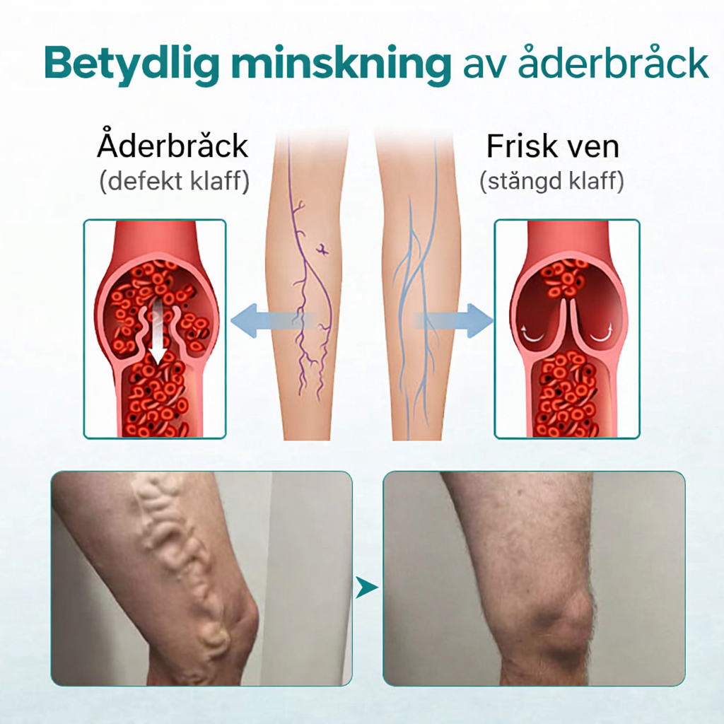 VenaLindra™ – Mikronålsplåster för stöd av vener och lindring av tunga ben