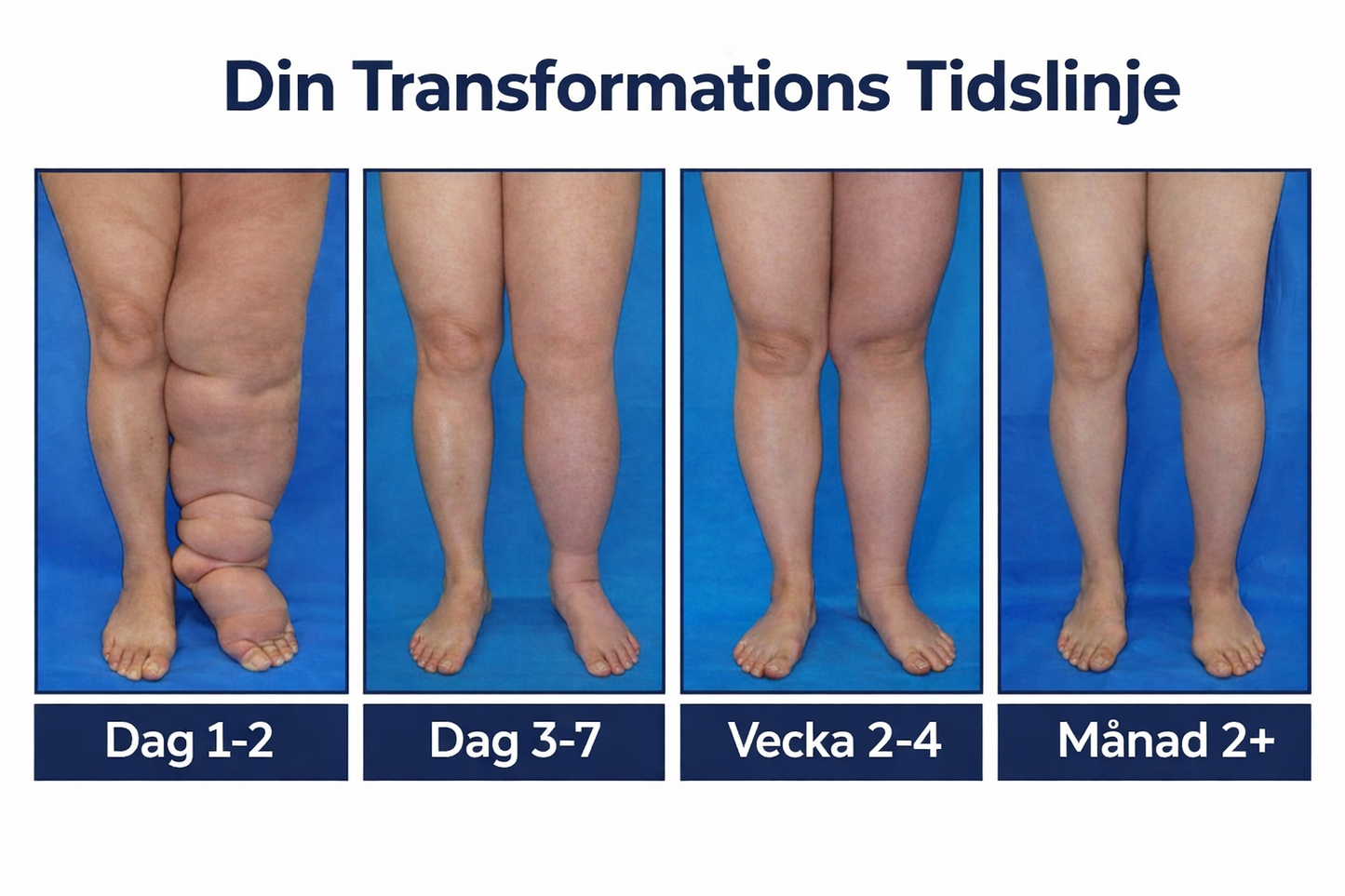 BenRo™ – Lindrande benkräm för lättare ben och bättre blodcirkulation