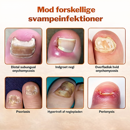 KlarNagel™ – Avancerad Svampdödande Nagelvårdsspray